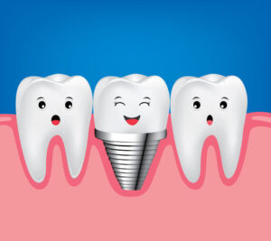Dental Implant Images