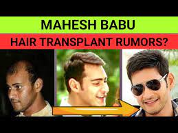 Mahesh Babu hair Transplant